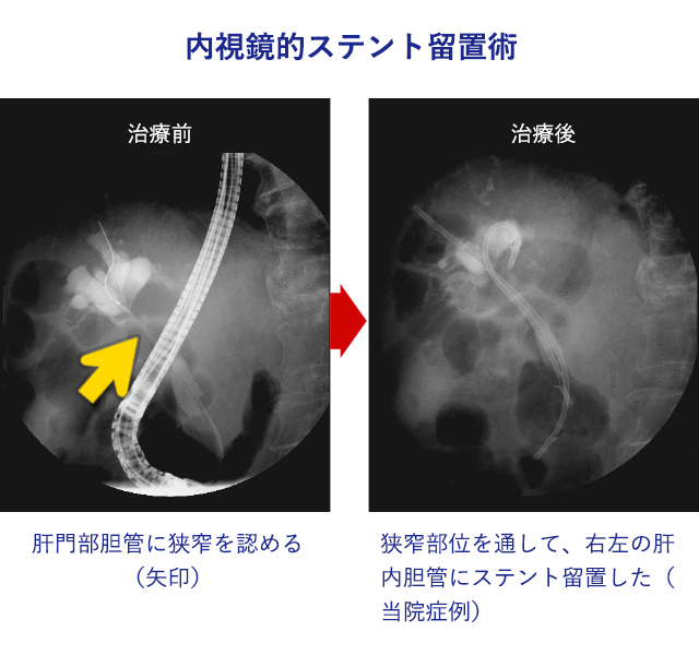 内視鏡的胆管ステント留置術